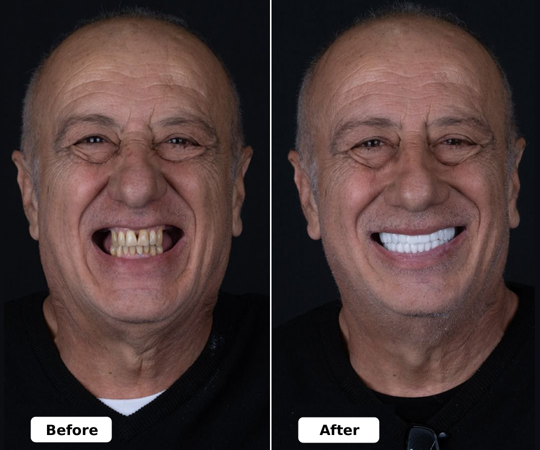 Best-Dental-implant-in-Turk